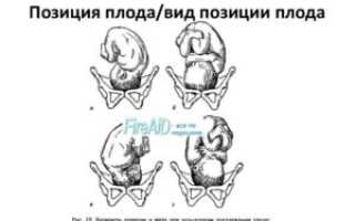 Головное предлежание плода 1 позиция передний вид