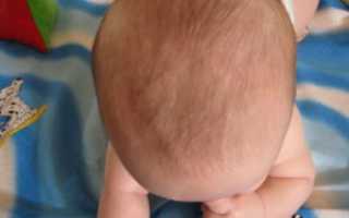 Если рано закрылся родничок у ребенка
