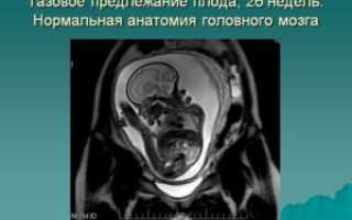 Что такое тазовое предлежание плода в 20 недель