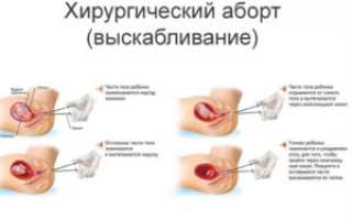 После аборта повторное выскабливание