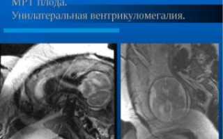 Вентрикуломегалия у плода односторонняя